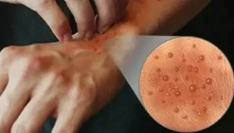 Natürliche Seifenherstellung 3 Flüssigseife-Schäden